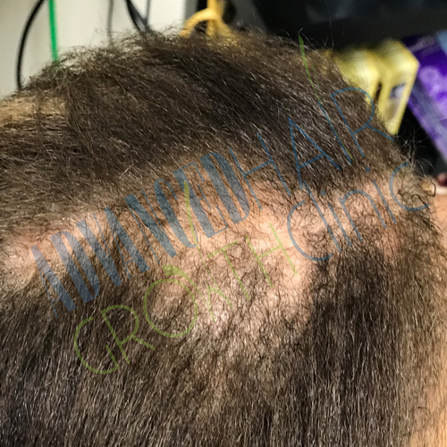 Tinea capitis before treatment