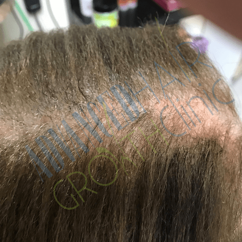 Tinea capitis after 12 weeks
