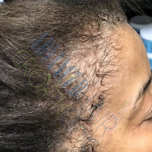 Traction alopecia before treatment