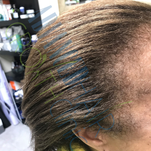 Traction alopecia after 12 weeks