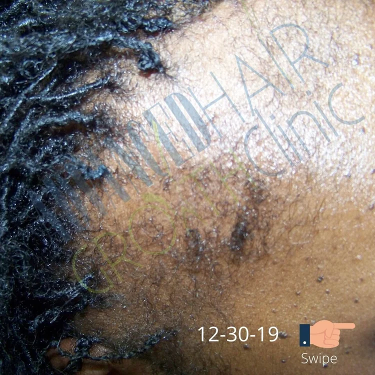 Before — hair loss and thinning, Charlotte NC