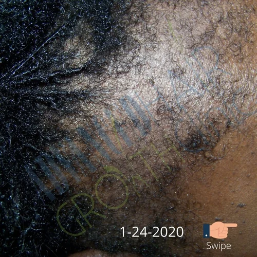 Traction alopecia after 6 weeks