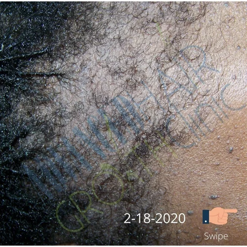 Traction alopecia after 12 weeks