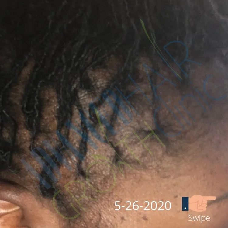 After — hair regrowth result, Matthews NC