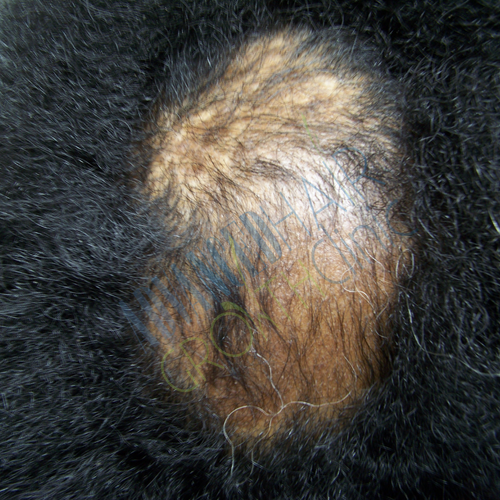 Alopecia areata regrowth beginning
