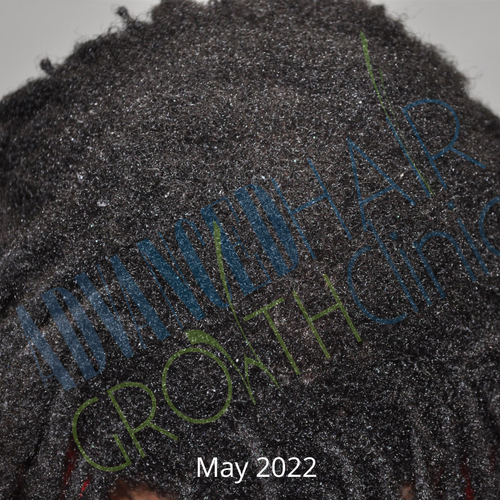 Diffuse thinning after 8 weeks