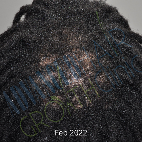 Diffuse thinning before treatment