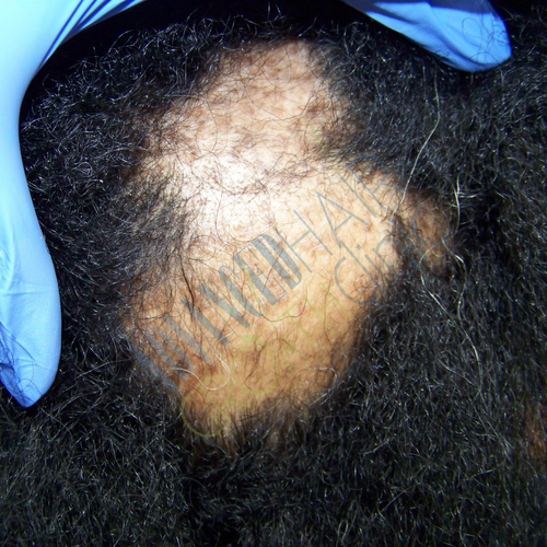 Alopecia areata before treatment