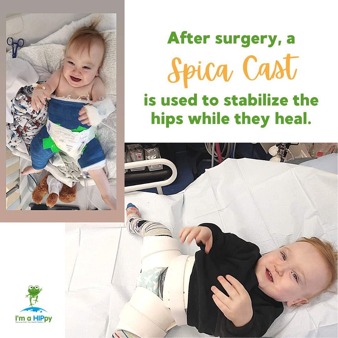 Some babies with hip dysplasia will require surgery, even if a diagnosis is made early on.

👶 Post-surgery, the baby will be placed in a Spica cast for about 3 months.

Typically, the child will wear the cast for 6 weeks, after which they will retur