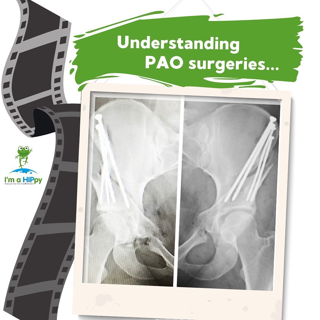 🥼 PAO stands for &ldquo;periacetabular osteotomy.&rdquo;

It is a surgical treatment option for adolescents and young adults with hip dysplasia.

During a PAO, a series of cuts are made to the bone (osteotomies) around the hip socket in order to rot