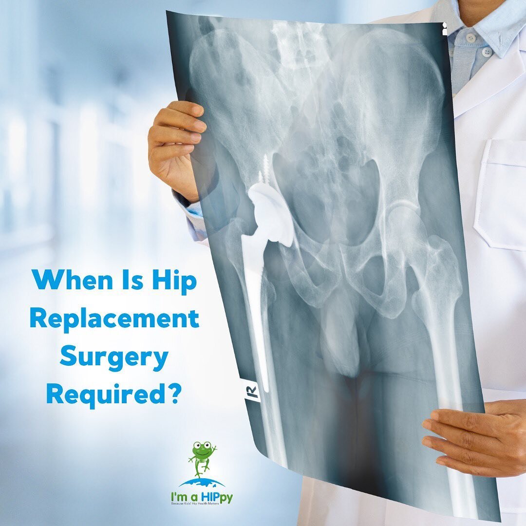 For some hip dysplasia patients &ndash; a hip replacement will be required later on in life.

⏳Many cases that require a hip replacement are due to a late diagnosis, which can lead to more significant damage to the hip joint over time.

Many patients