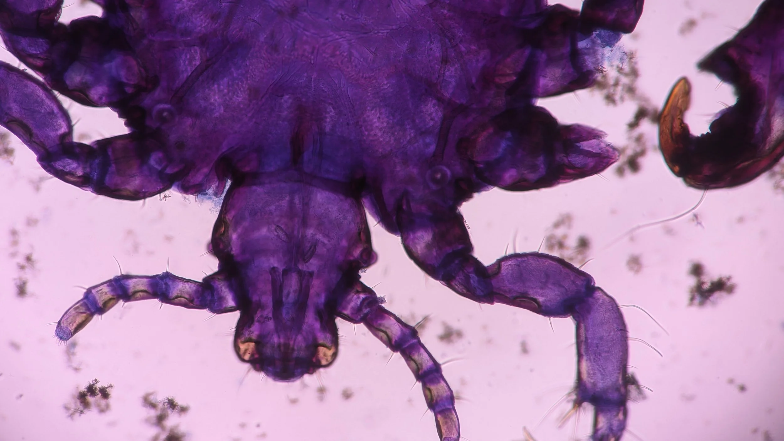 Demodex Mites: The Hidden Cause of Perioral Dermatitis?