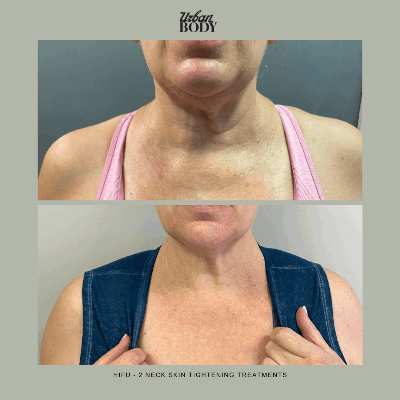 HIFU-Neck-tightening-2sessions.png