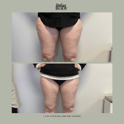Fat_freeze-outer-thighs-2sessions.png