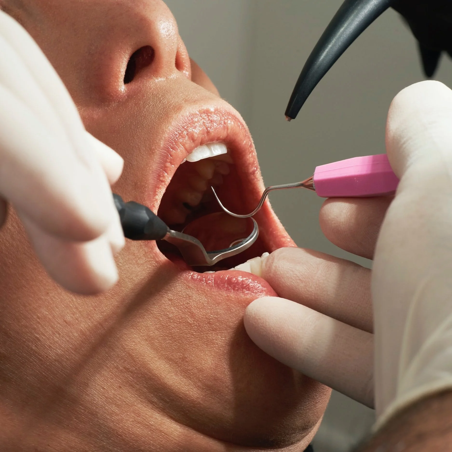 The Numbing Agent is Optional