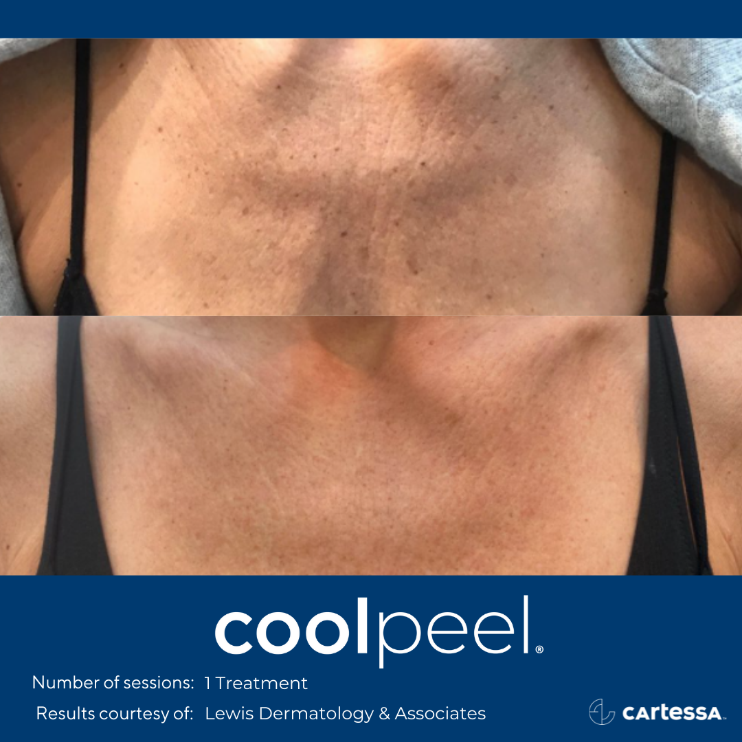 Cool Peel CO2 Laser Resurfacing — The Skin Spot Laser Club Cape Coral