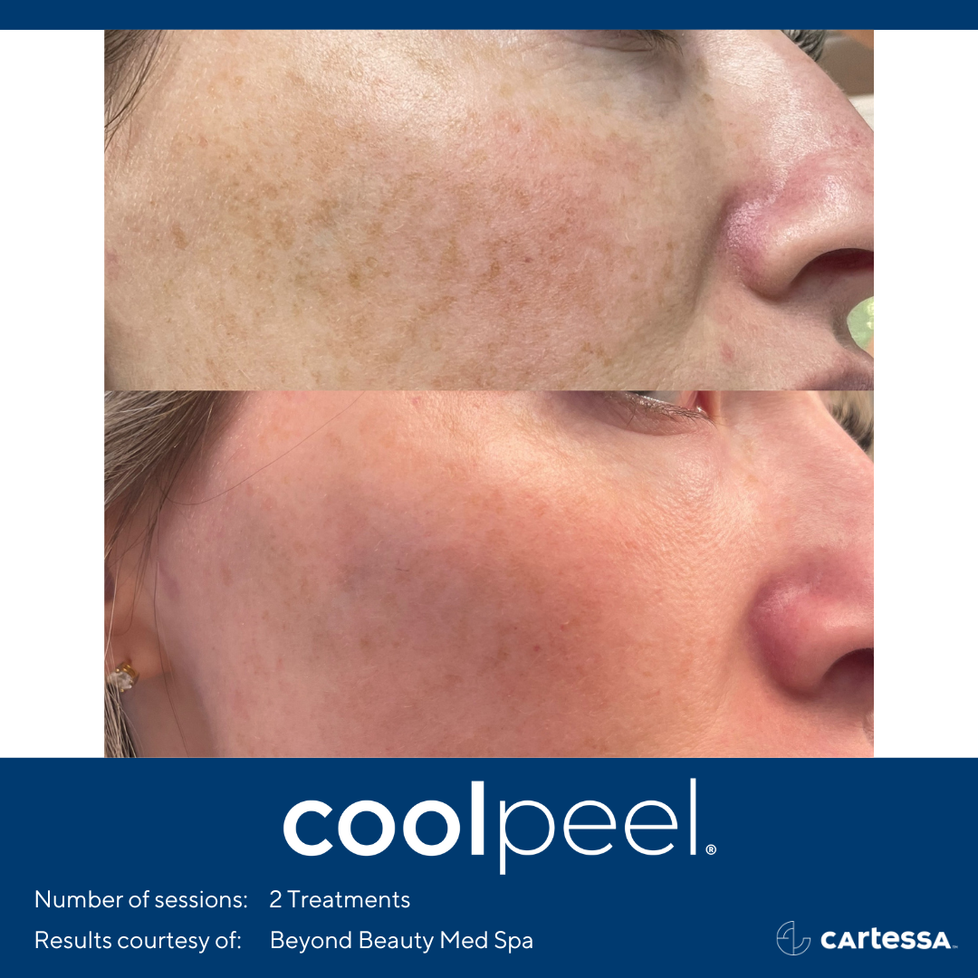 Cool Peel CO2 Laser Resurfacing — The Skin Spot Laser Club Cape Coral