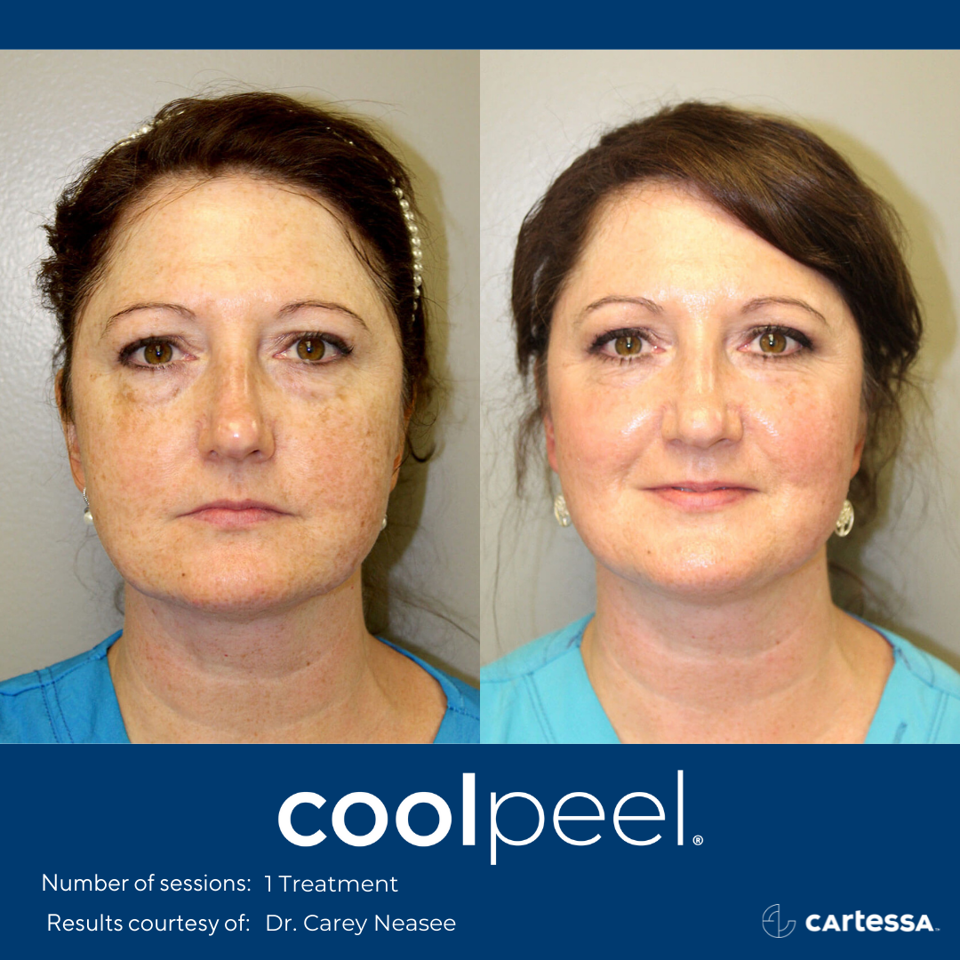 Laser Skin Resurfacing: CoolPeel, CO2 Laser - Maryland