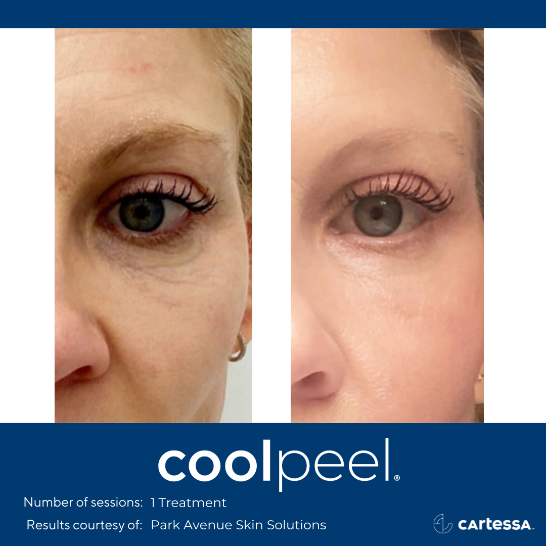 Cool Peel CO2 Laser Resurfacing — The Skin Spot Laser Club Cape Coral