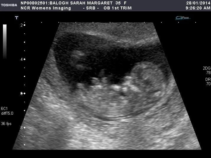 Ultrasound picture of my son Xavier at 12 weeks