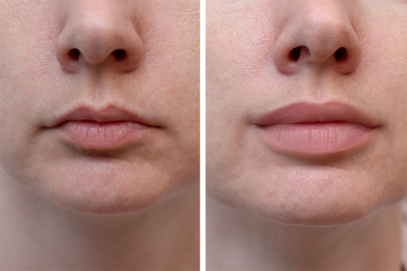 Lip-filler-–-Before-&-After.png