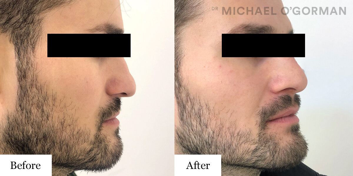 Non-surgical-Rhinoplasty---Before-&-After.jpg