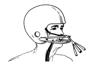 Balloon Tamponade in GI Bleed — USF Emergency Medicine