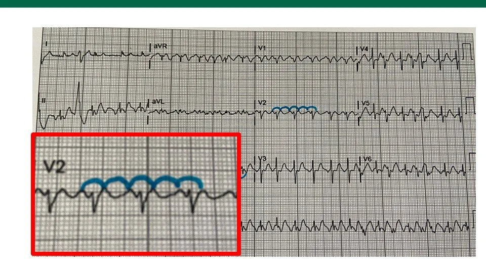 Inverted A Flutter SVT on the ECG! — USF Emergency Medicine