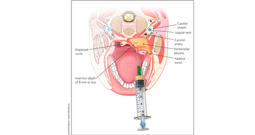 Guide on POCUS for PTA — USF Emergency Medicine