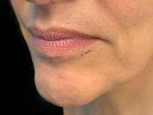 DRSHAHD-LIPS-BEFORE-1.jpg