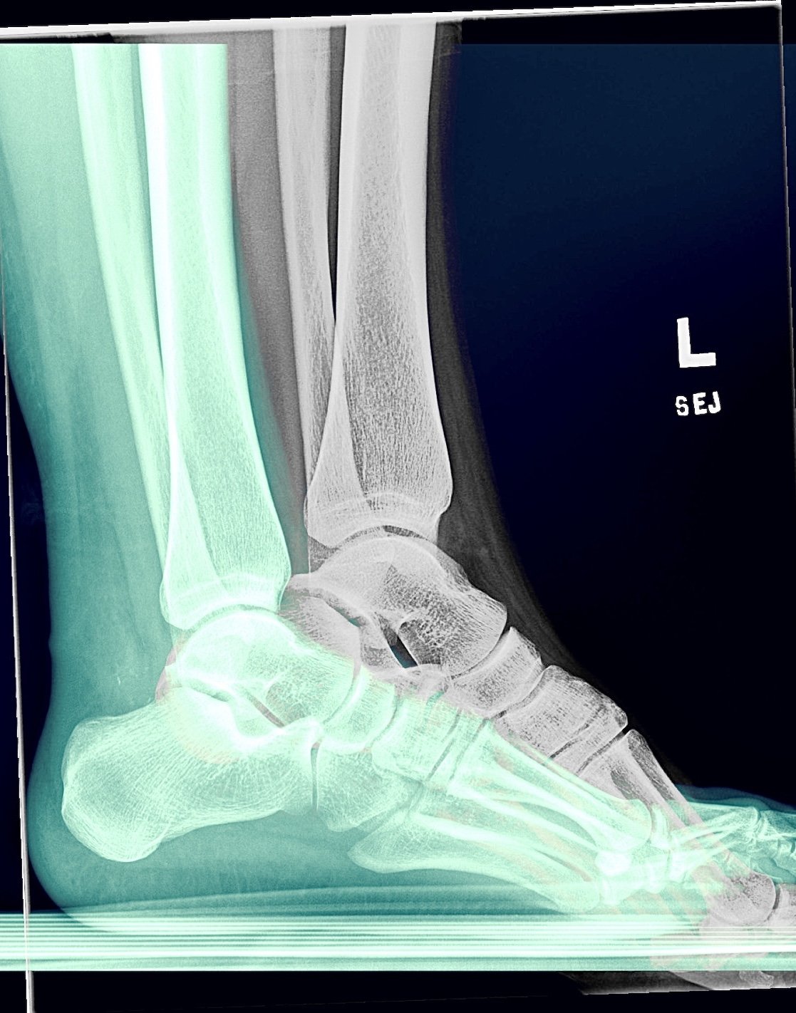 Left Ankle X-Rays: Before and After Surgery (2020)