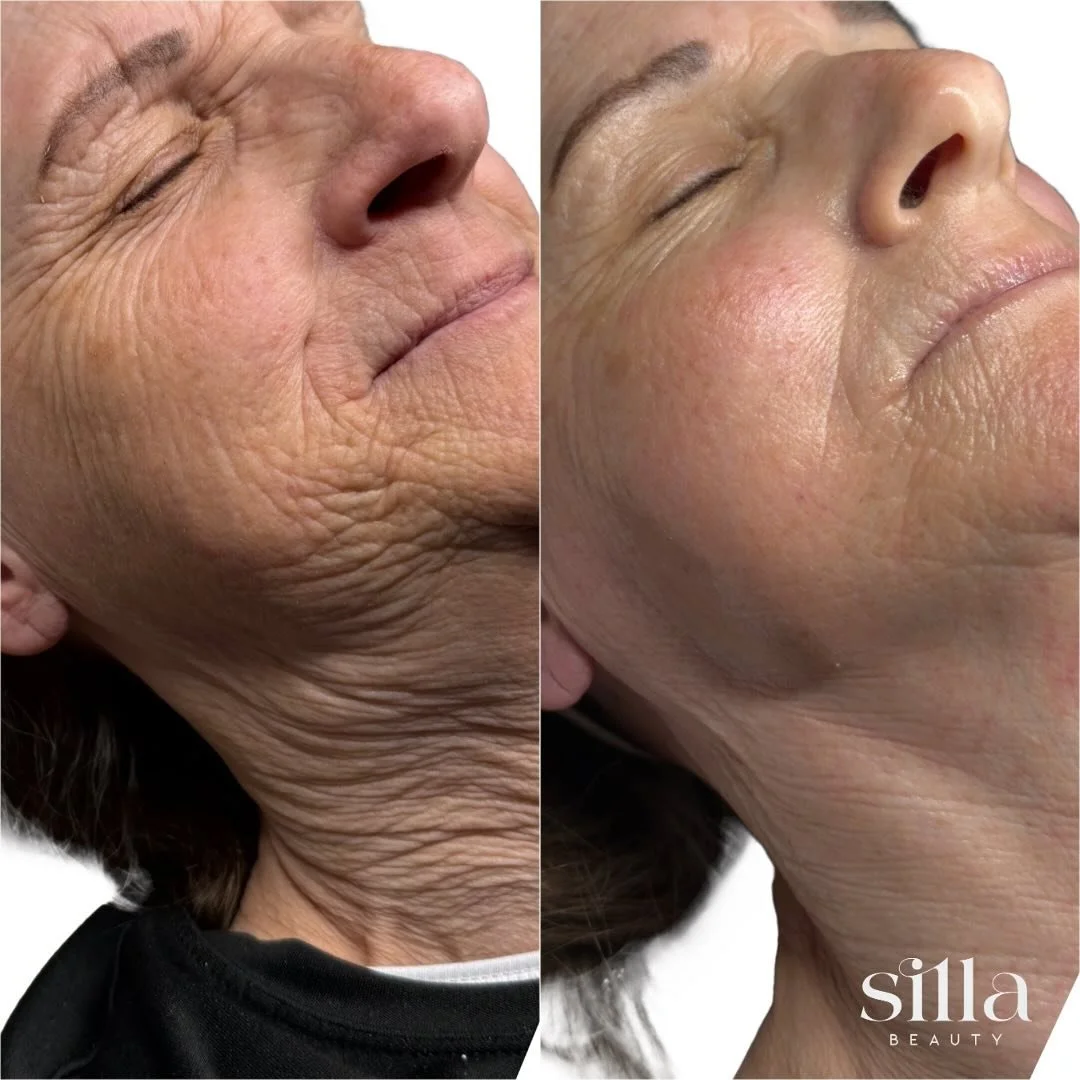 🤍 Luxe Lift magic! 
She left with visibly lifted, firmer, radiant skin.
These results are instant and will last 5-8 days with no downtime, making it an ideal facial before any event, photoshoot, or when your skin just needs that extra wow factor!

✨