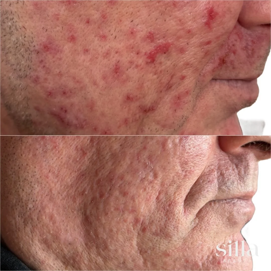 ✨ ONE WEEK. That&rsquo;s all it took for these results using the Restorative HA Serum! 

My client came in with red, irritated skin and after just 7 days of consistent use (no other changes!), his skin is visibly calmer, more hydrated, and already st