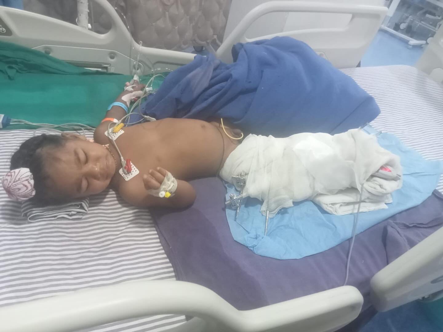 With Wahegurus grace we have blessed to be paying towards the costs of those kids operation. His village has raised most of the monies for the broken bone. He still needs a skin graft but the parents have no monies and the hospital won’t operat