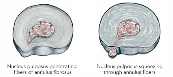 Pulpus Spinal Anatomy – The American Center for Spine and Neurosurgery — ACSN