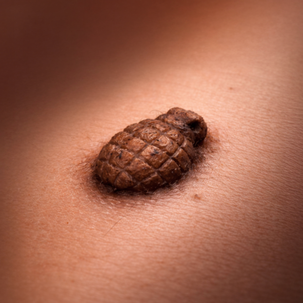 MoleMap: A Mole Might Kill You