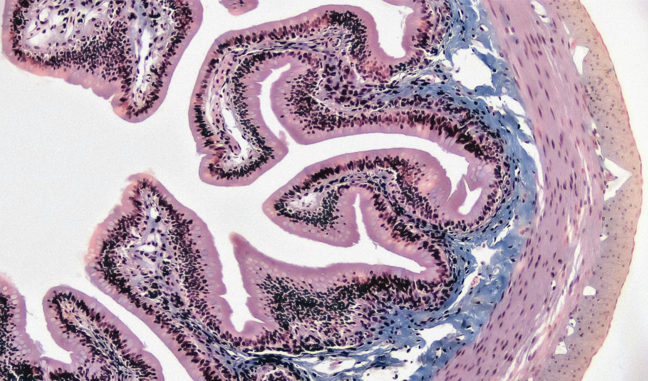 BiomeFx Case Study: Microbiome Dysfunction, Histamine Reactivity, and Immune Regulation