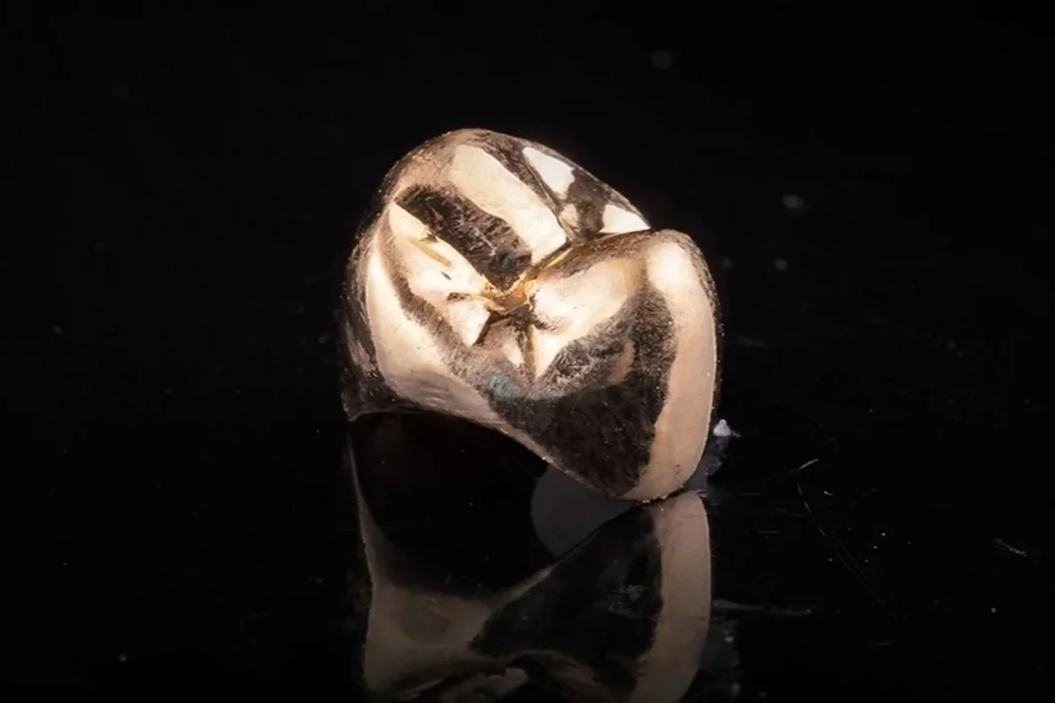 Full-Metal Gold Crowns