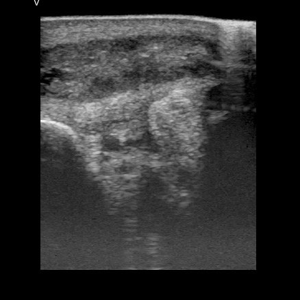 Lumps and bumps