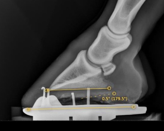 Foot balance - Palmar or plantar angle