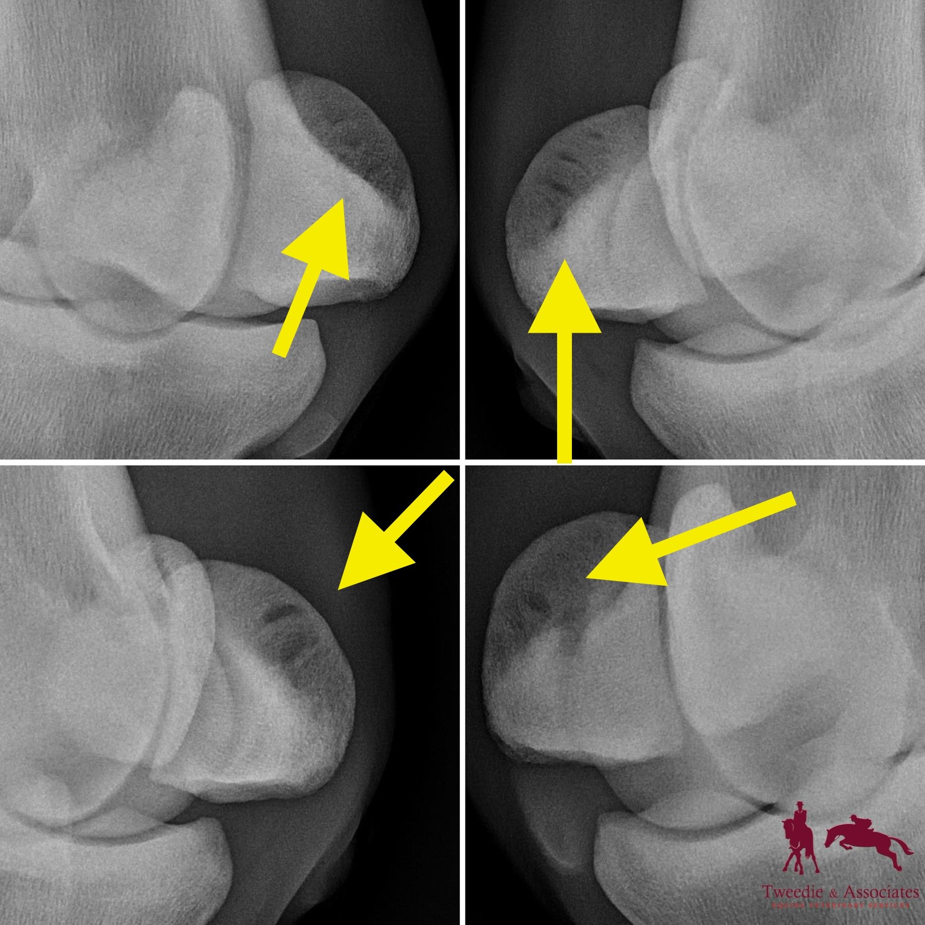 Sesamoiditis