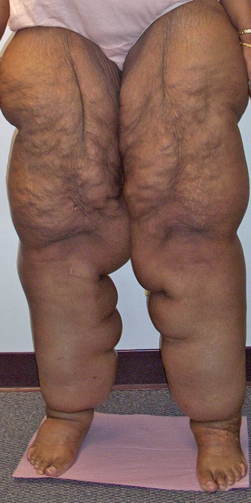 d30-XXX 2 LE lipo lymphedema obesity stage III.jpg