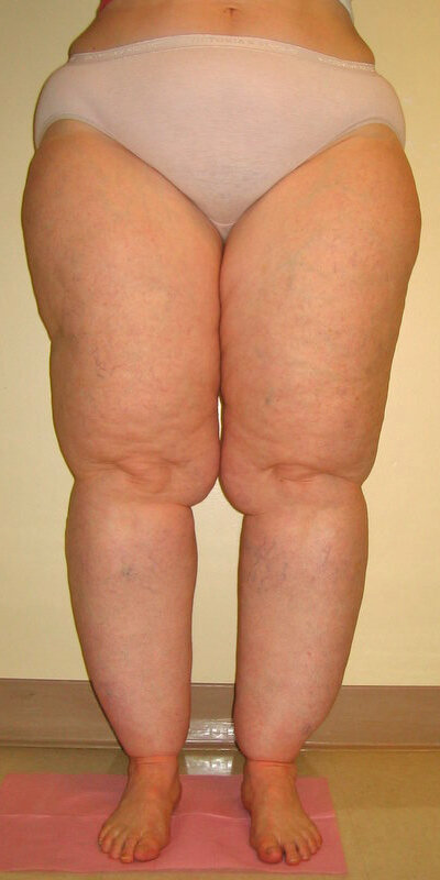 d26-Lipedema Stage II.jpg