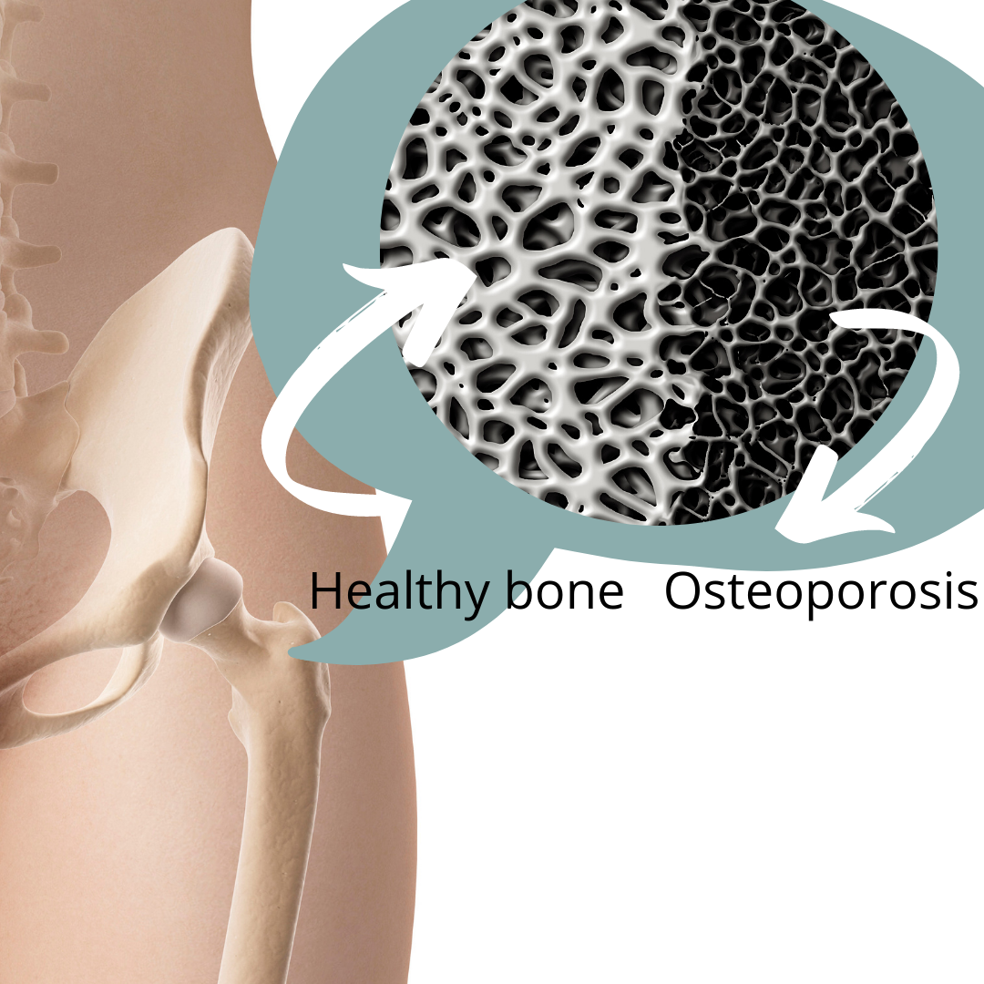 InHouse Pilates blog Osteoporosis - Symptoms, diagnoses, and 9 ways you can prevent it hip bone showing normal bone and osteoporosis.