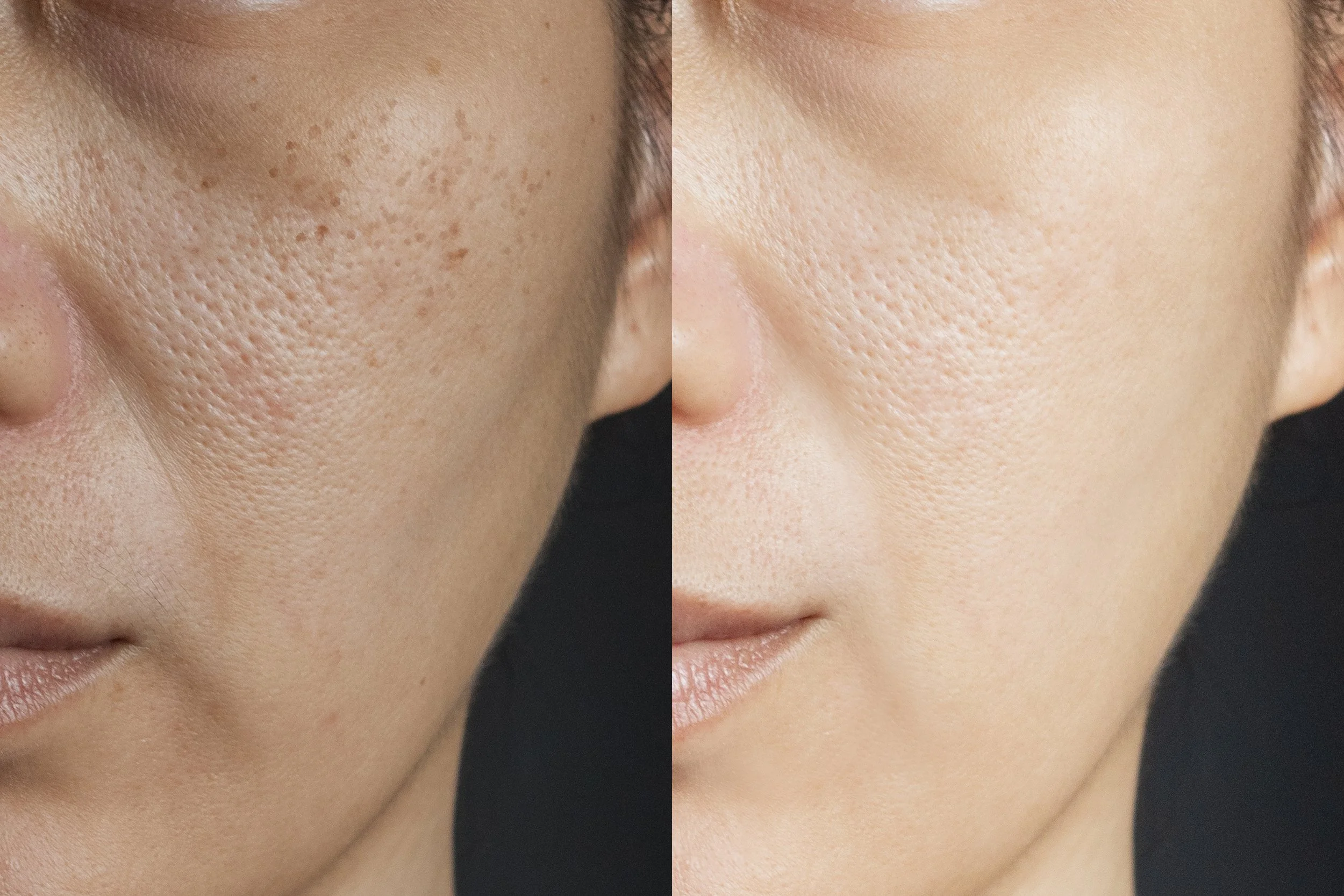Comparison of a woman's face showing skin with acne scars on the left and clear, smooth skin on the right.