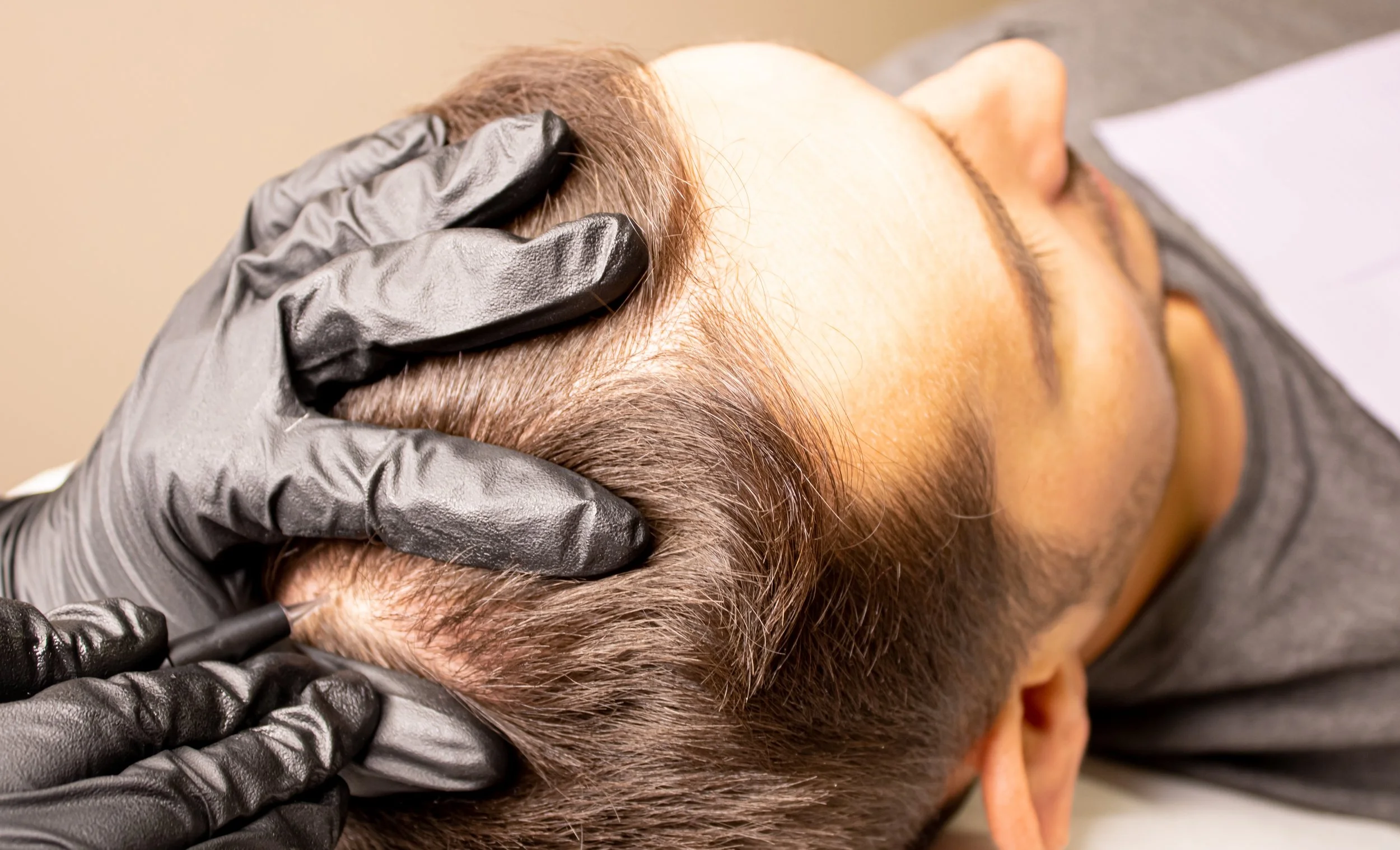 A person receiving a hair tattoo or scalp micropigmentation procedure, with a technician wearing black gloves applying pigment to the scalp.