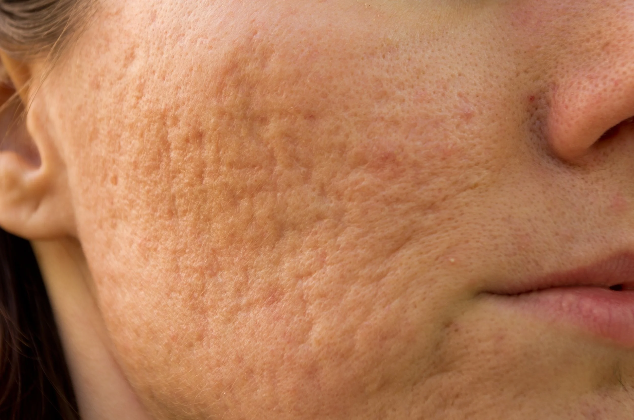 Close-up of a woman's face showing skin with acne scars and uneven texture.