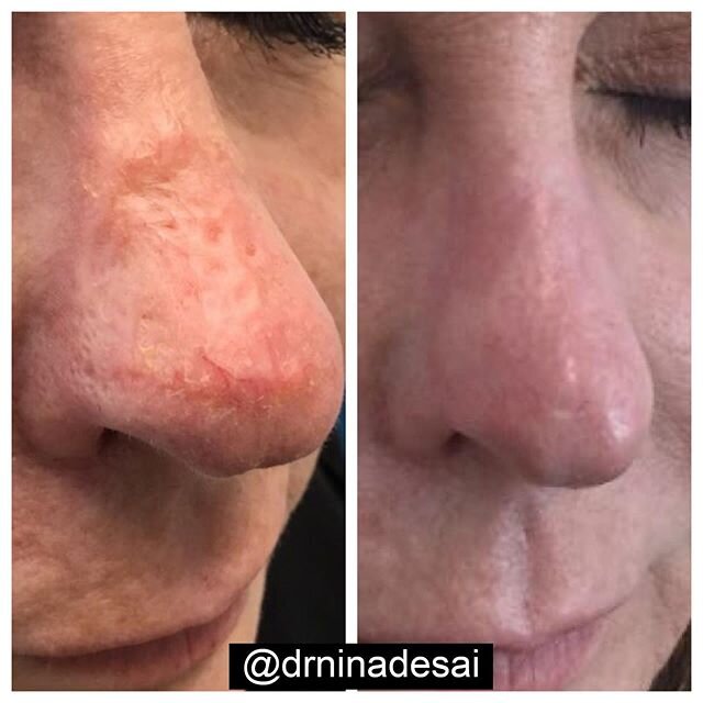 One of my absolute favorite before and after pictures! This patient came to me to treat a large scar on her nose. 3 resurfacing treatments later she is ecstatic. I love that she feels confident again and feels that she can live her life normally. Sca