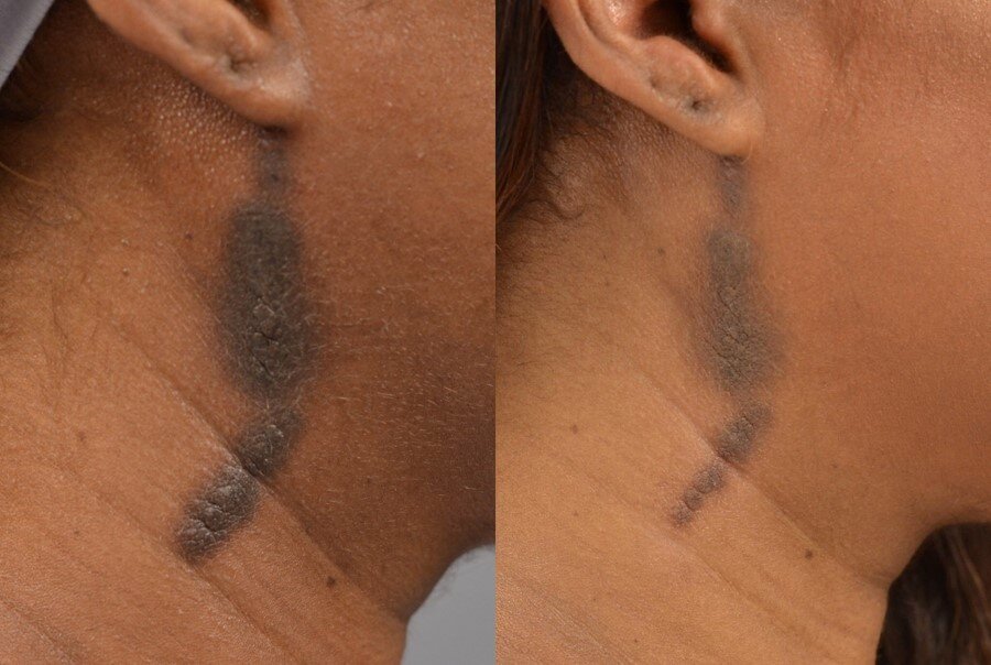 Fraxel resurfacing for lightening birth mark.