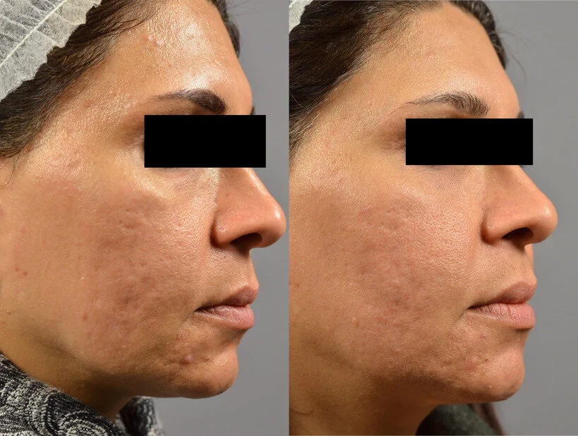 Profractional resurfacing for acne scars - 2 treatments.